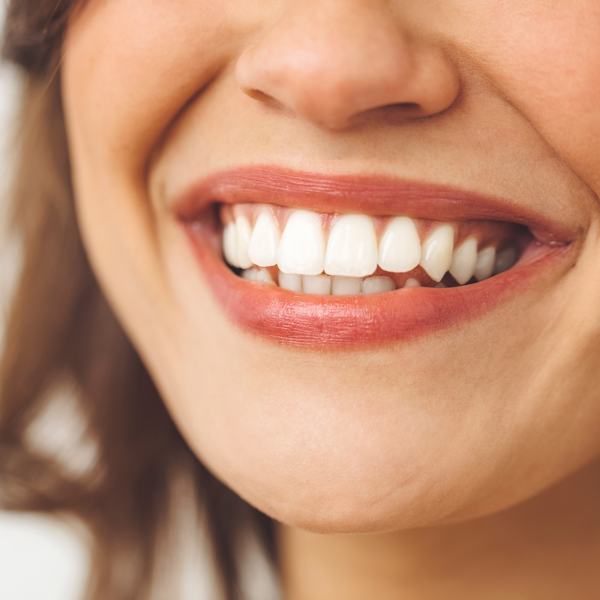 Composite veneers being applied