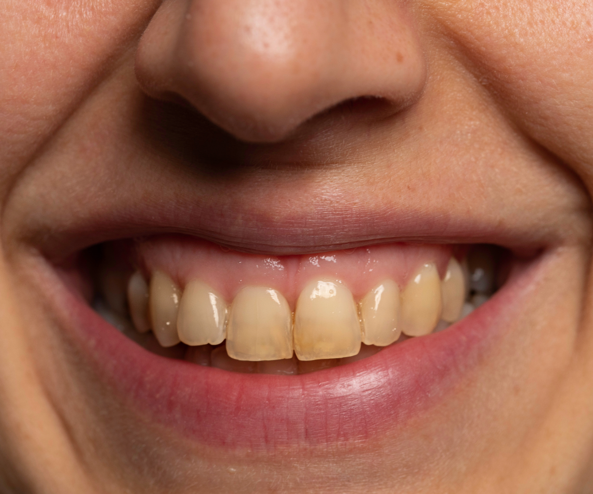 Severe discolouration