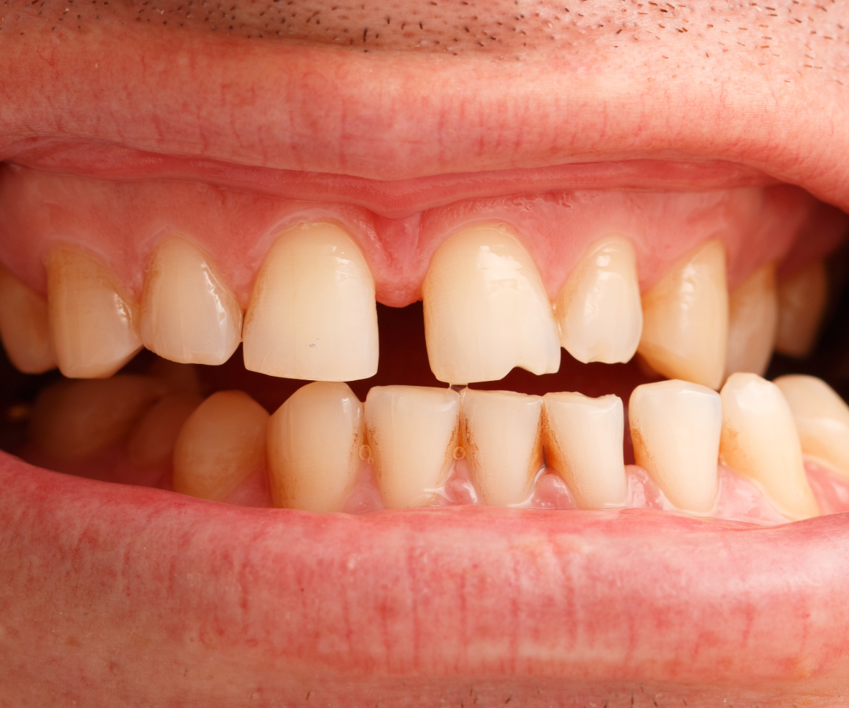 Irregular tooth shape