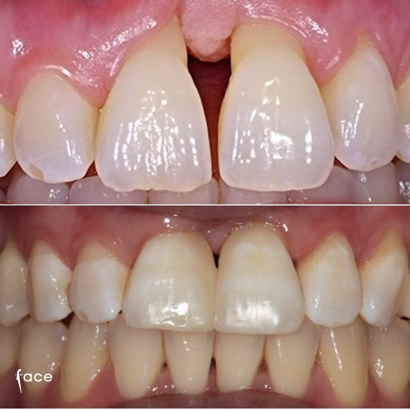 Gum grafts & bonding