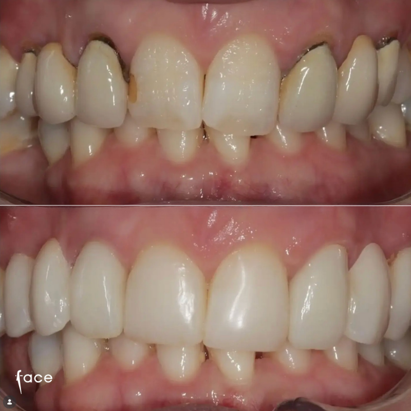 Whitening, bridge & bonding