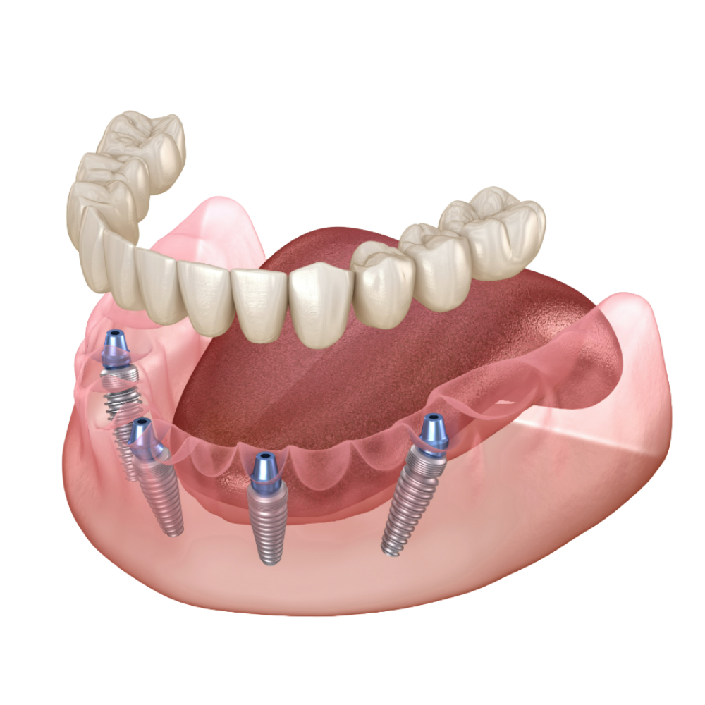 All-on-4 dental implants