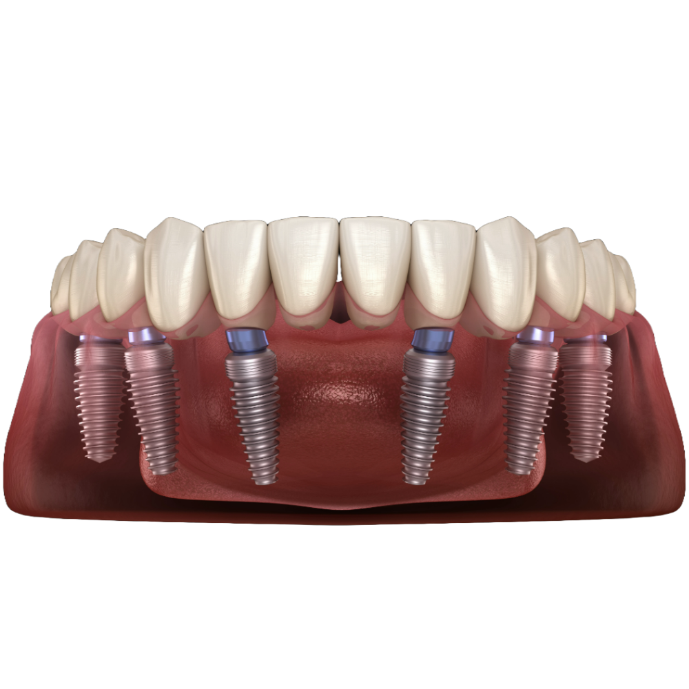 All-on-6 dental implants
