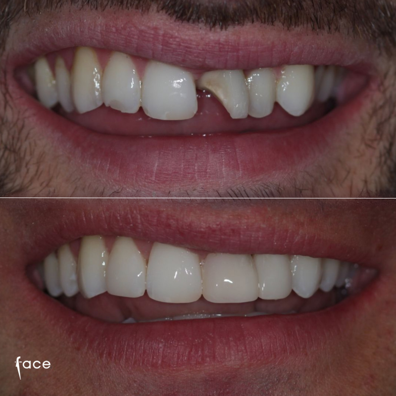 Composite dental work