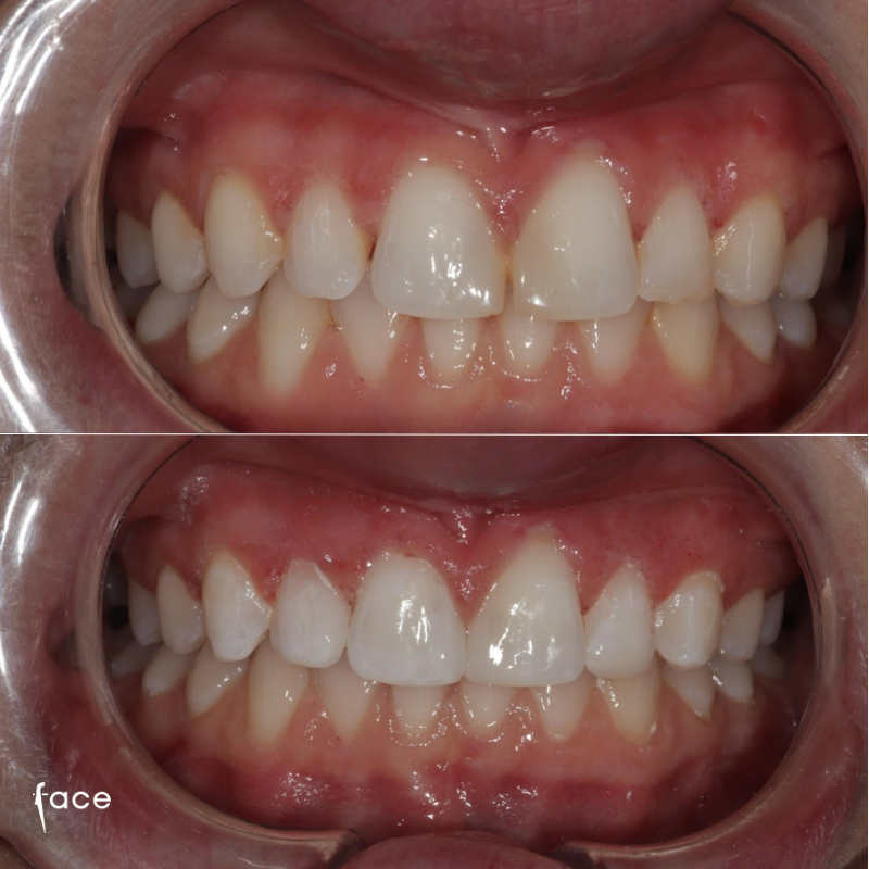 Bonding transformation