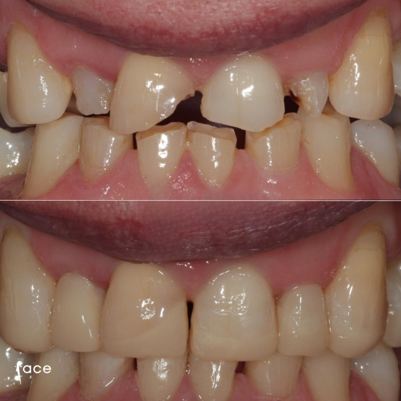 Composite restoration