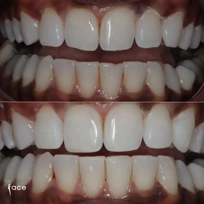 Composite bonding smile
