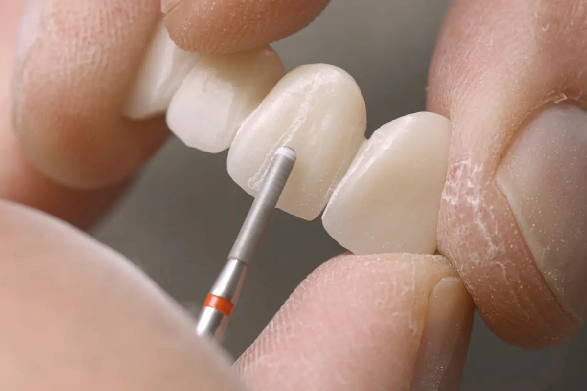 Dental bridge at Face Dental, Coventry