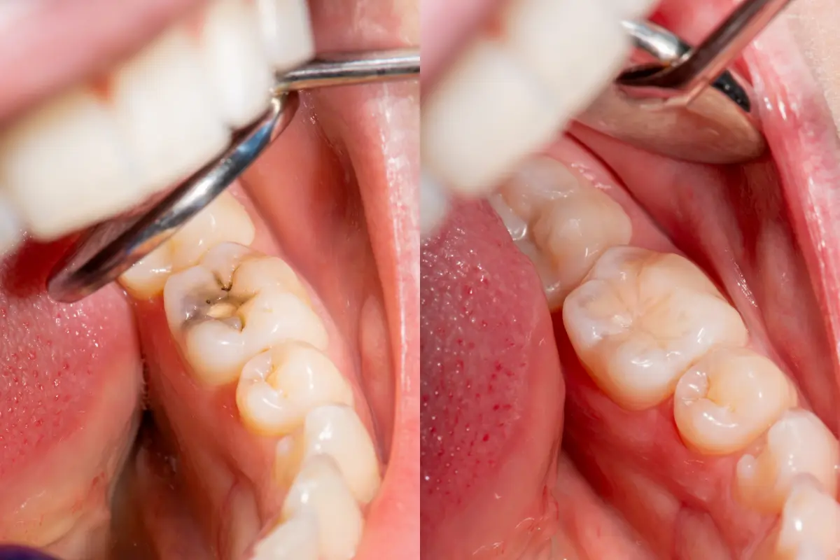 Dental fillings at Face Dental, Coventry