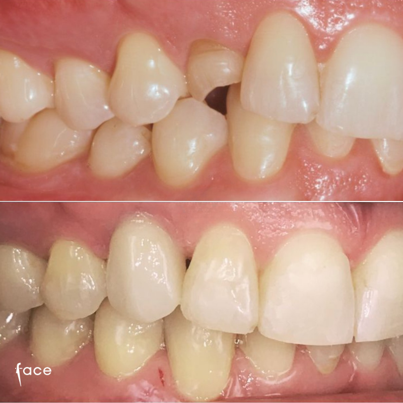 Dental implant restoration