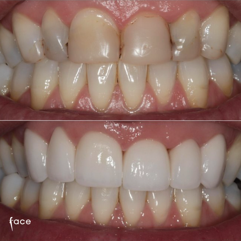 Emax crowns & whitening