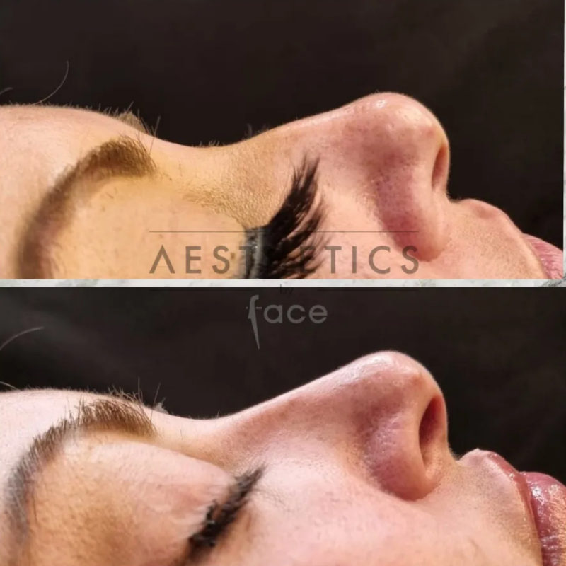 Cheek filler enhancement