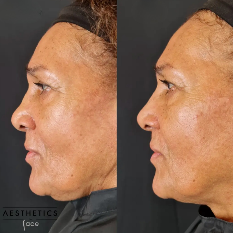 Lip enhancement results