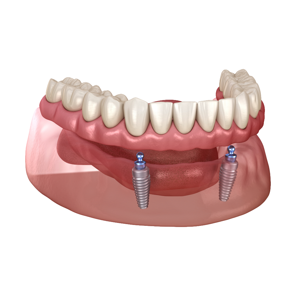 Implant-retained dentures as an alternative