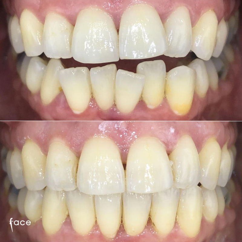 Invisalign clear aligners
