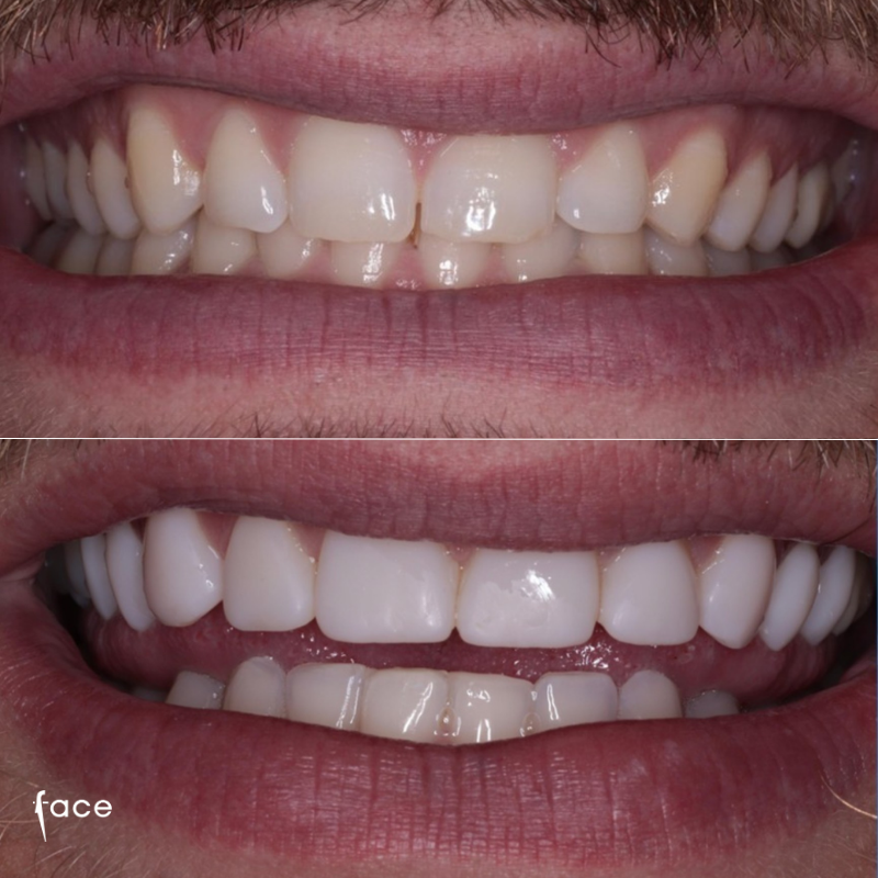 Invisalign, whitening & bonding