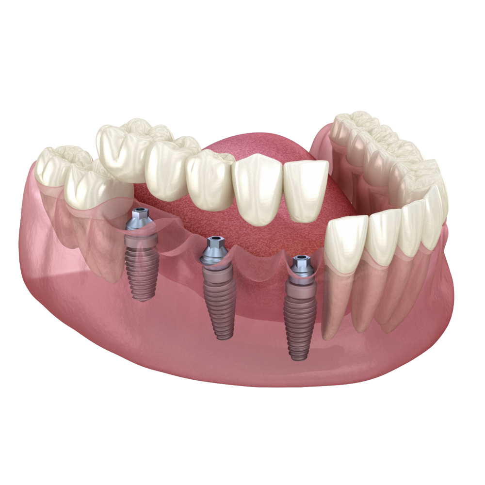 Multiple dental implants