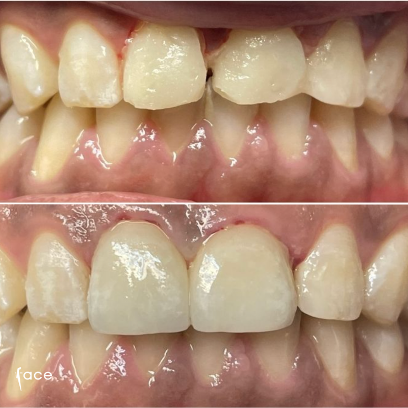 Root canal & Emax crowns