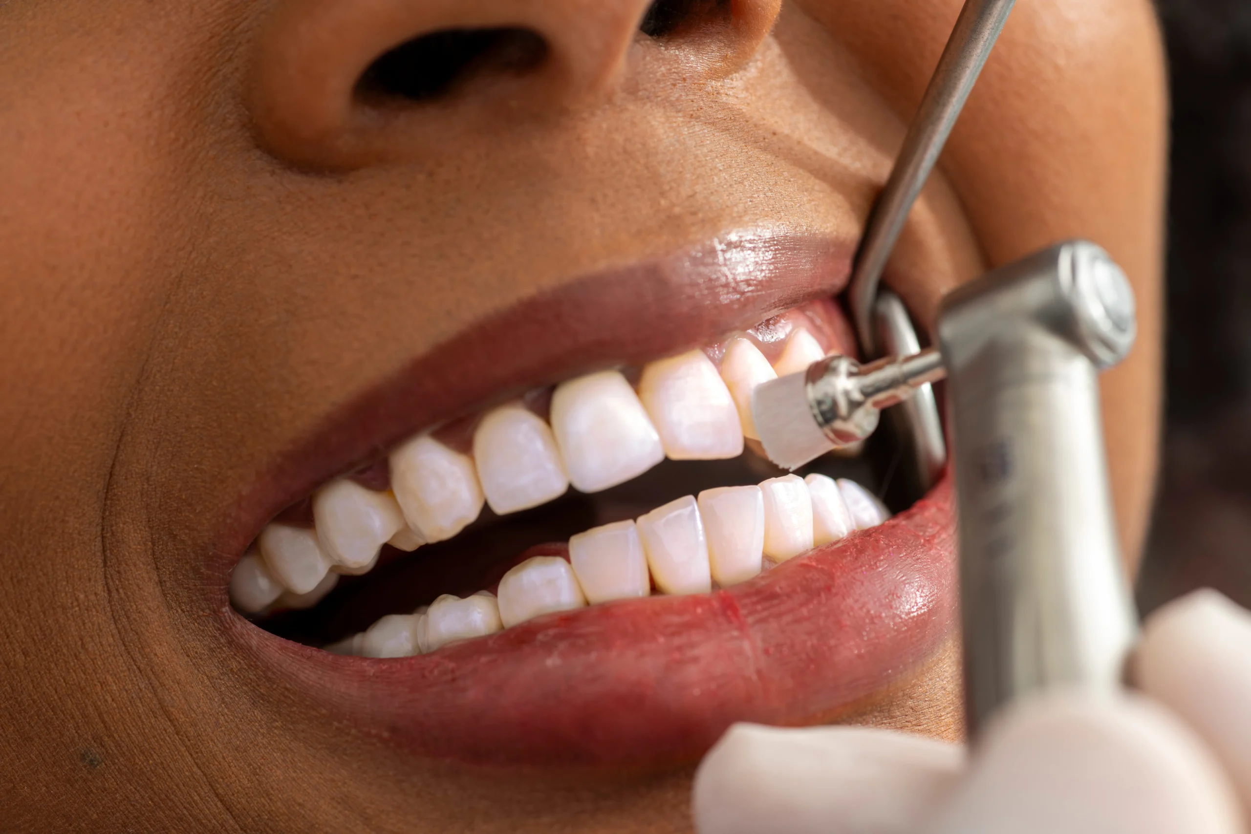 Scale and polish at Face Dental