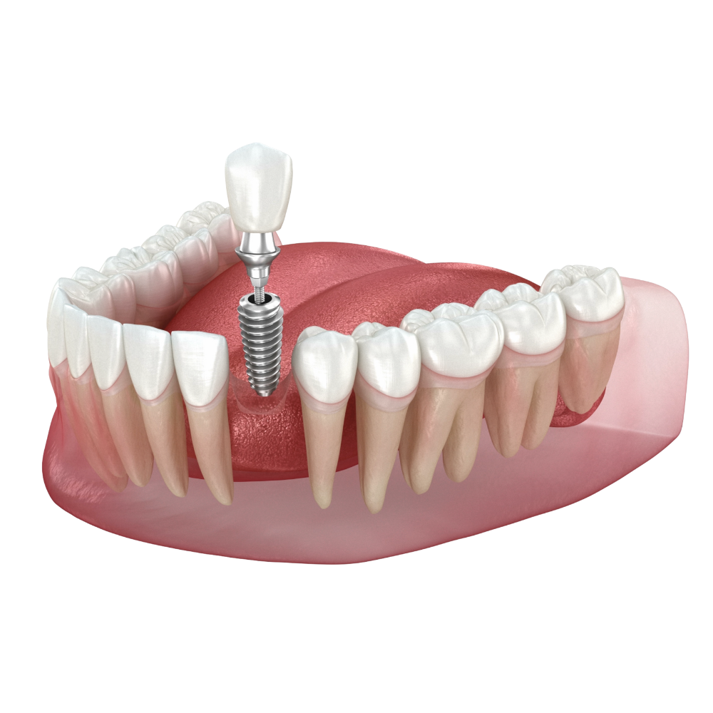 Single dental implant