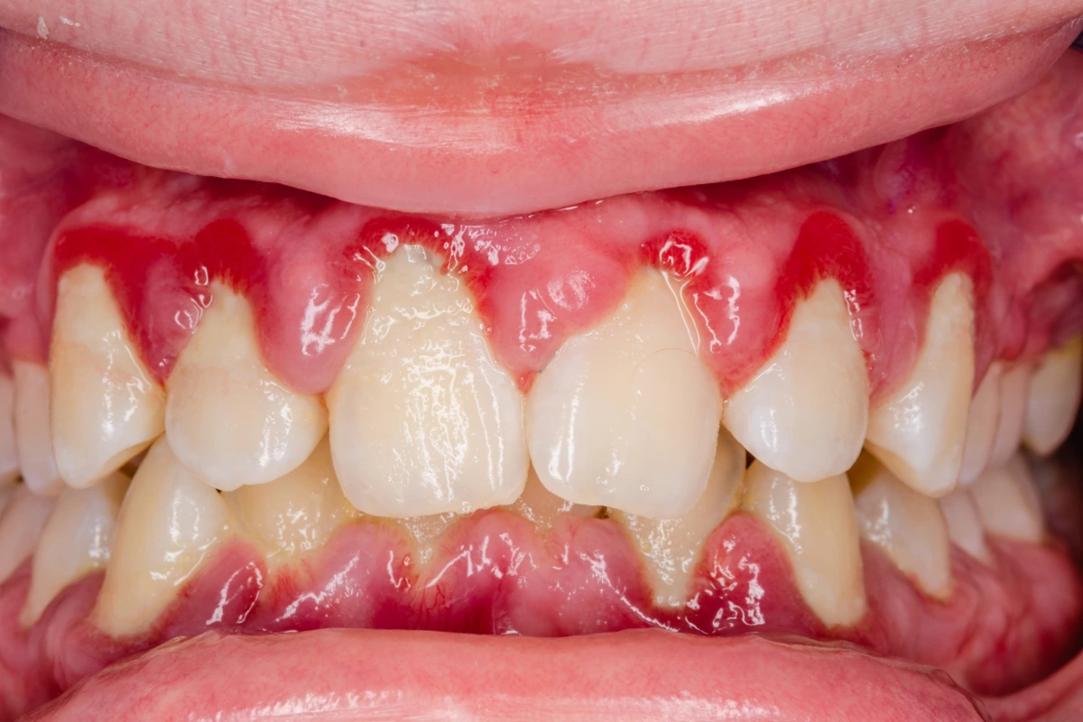 Swollen or red gums