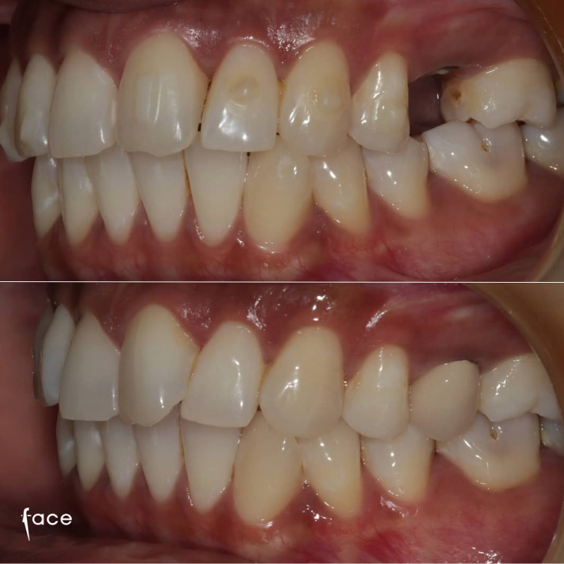 Whitening, Invisalign & implant