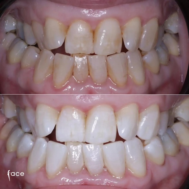 Teeth whitening transformation
