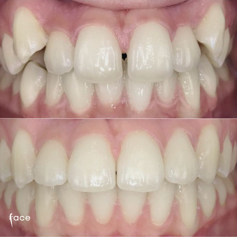 Traditional braces transformation